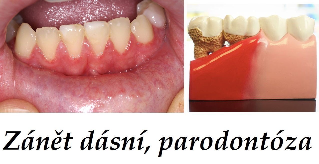 Dásně, zánět dásní, parodontóza - byliny, bylinky, babské rady, ústní voda, zubní olej