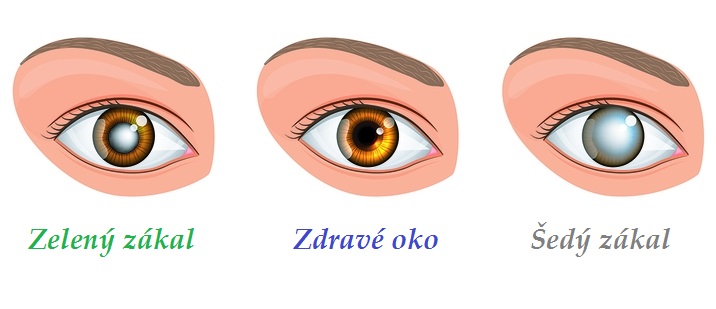 Šedý zákal, zelený zákal, nitrooční tlak - byliny, bylinky, babské rady